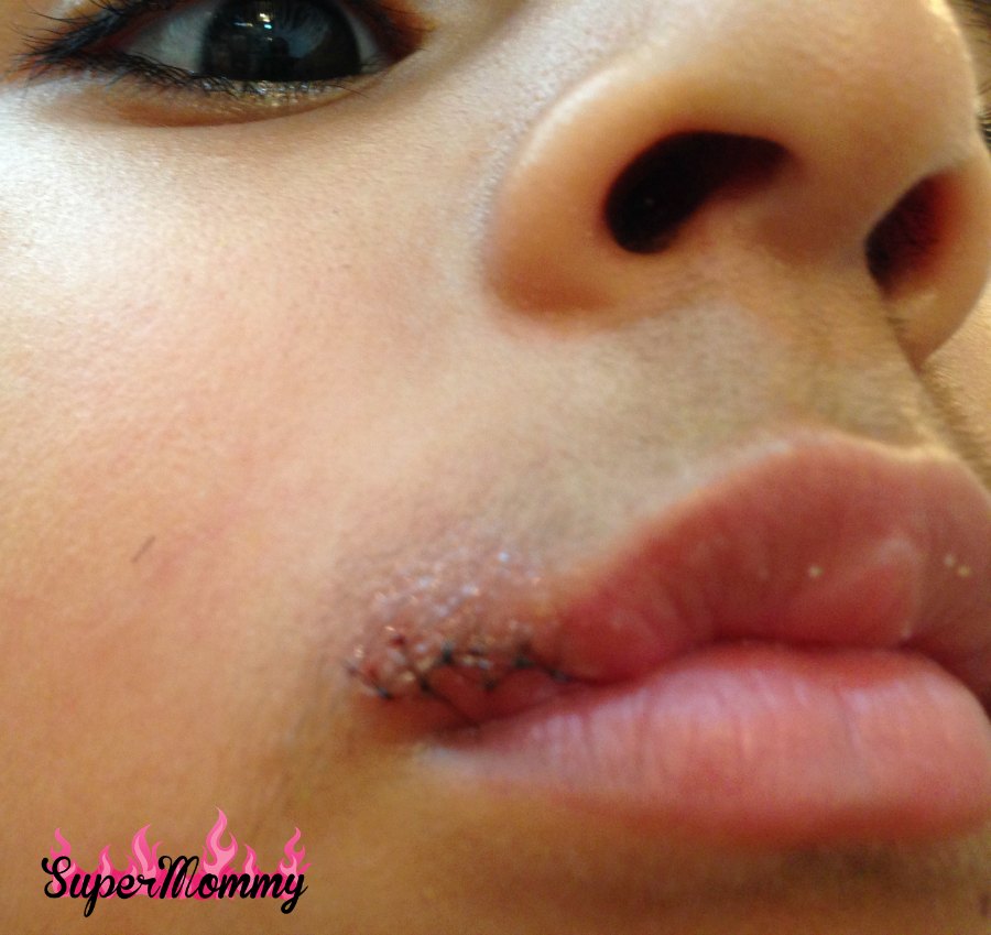 Kids Stitches on lip - Plastic Surgeon