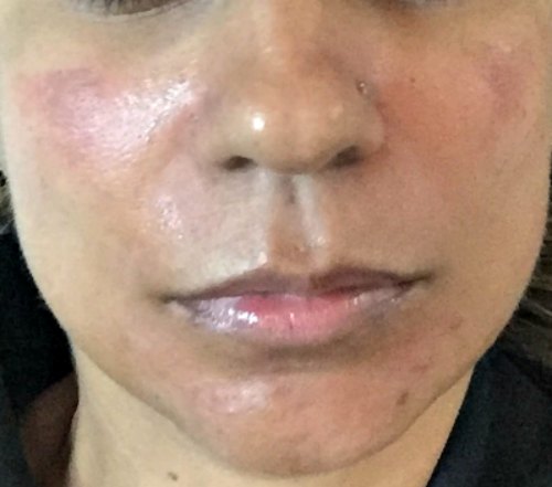 PICO Toning Discovery PICO Melasma Pigmentation Dark Spots Tattoo Removal Prive Aesthetics Singapore Laser Treatment Facial